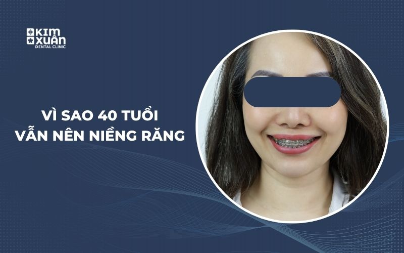 Vì Sao 40 Tuổi Vẫn Nên Niềng Răng