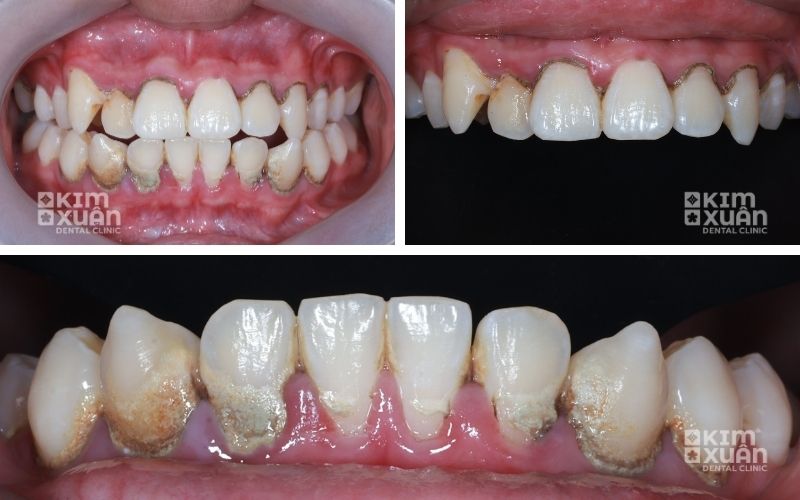 Viêm Nướu Răng, Viêm Lợi Gây Tụt Lợi